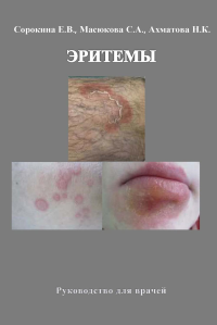 Эритемы. Руководство для врачей. Ахматова Н.К., Масюкова С.А., Сорокина Е.В.