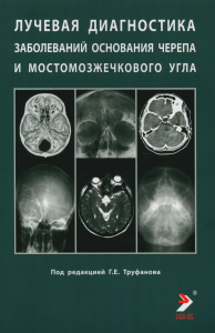 Лучевая диагностика заболеваний оснований черепа и мостмозжечкового угла: Учебное пособие