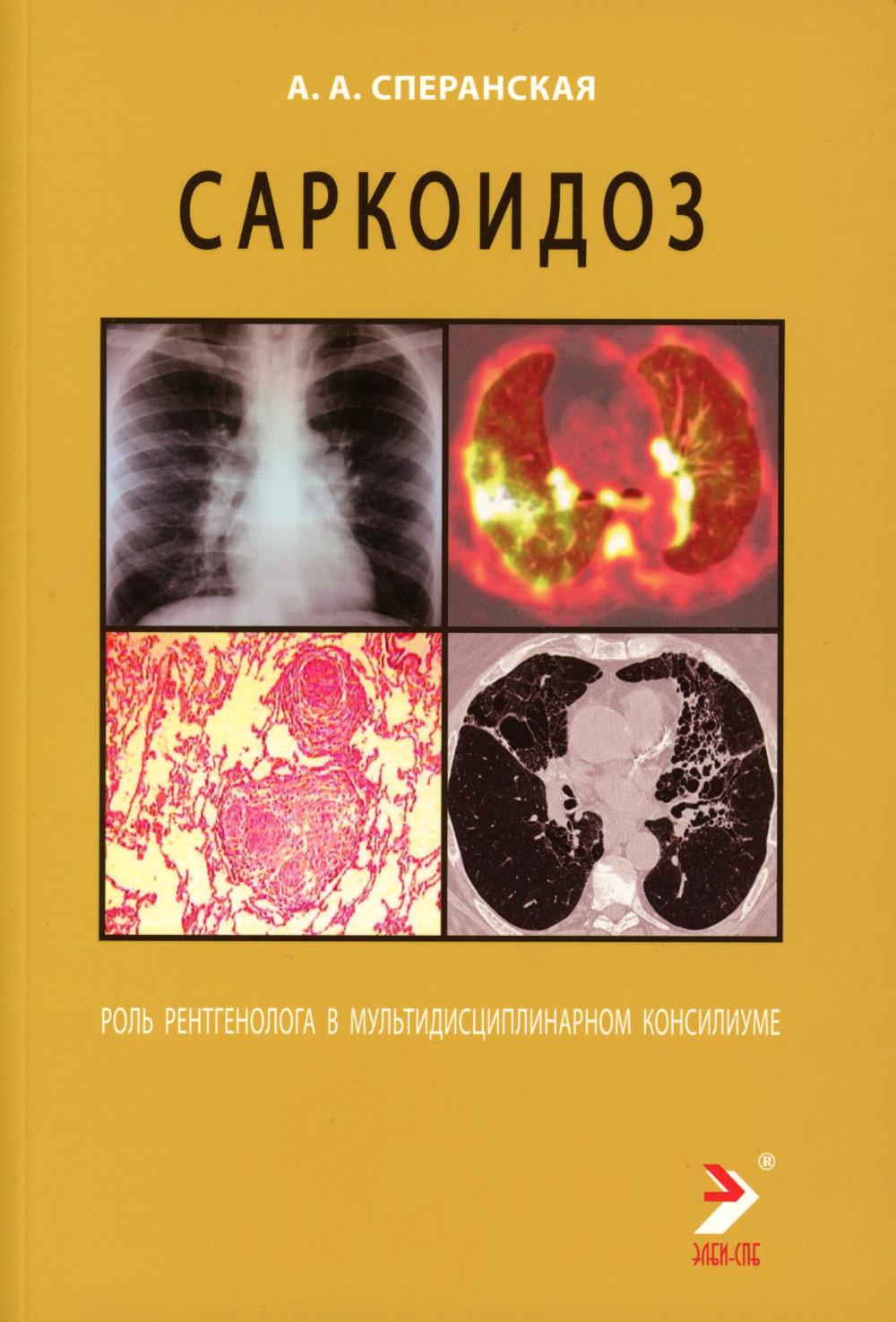 Саркоидоз. Роль ренгенолога в мультидисциплинарном консилиуме. Сперанская А.А.