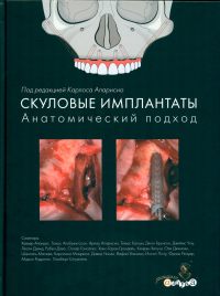 Скуловые имплантаты. Анатомический подход