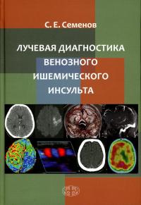 Лучевая диагностика венозного ишемического инсульта